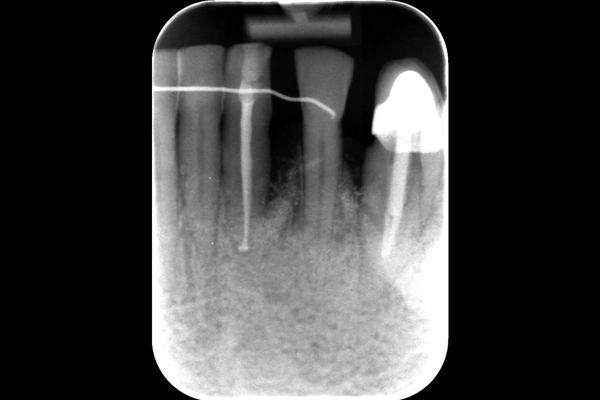 1.5-years_CASE_Rodrigo_Gonzalez_Terrats Radiographic outcome at 1.5-year follow-up