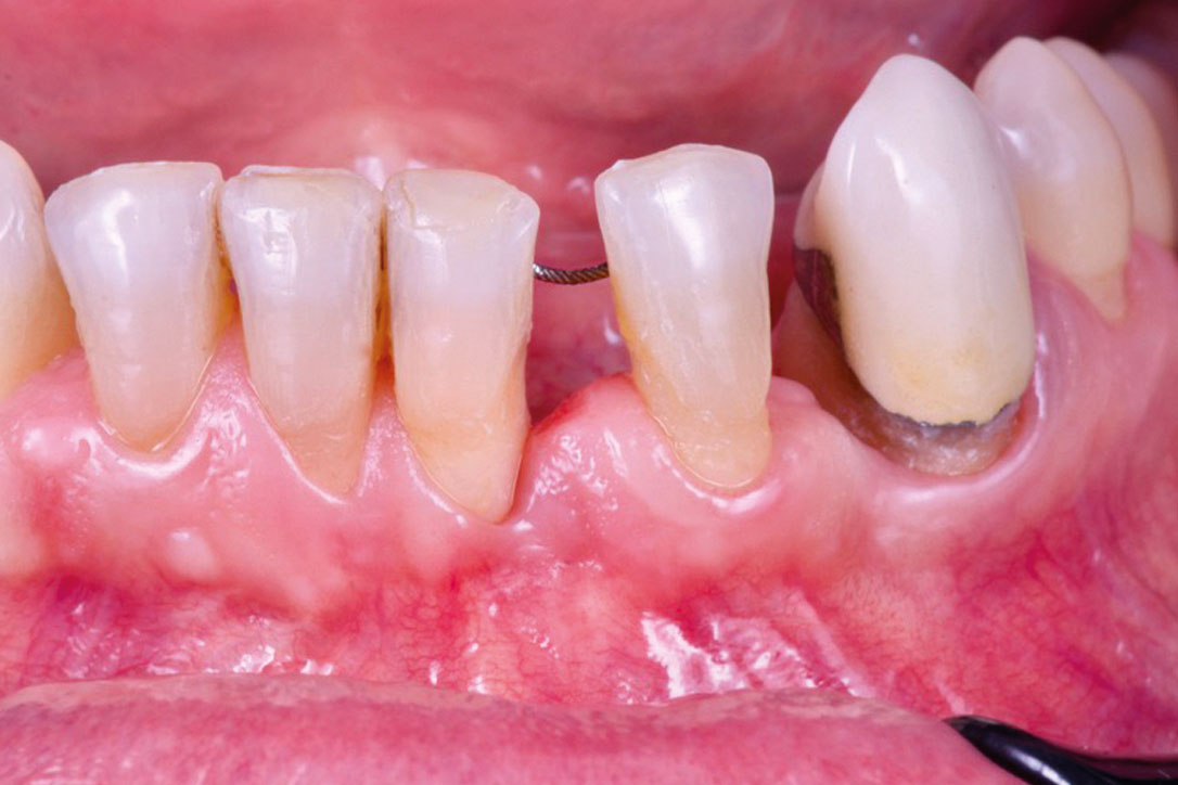 12---1-year_CASE_Rodrigo_Gonzalez_Terrats Clinical outcome at 12-month follow-up