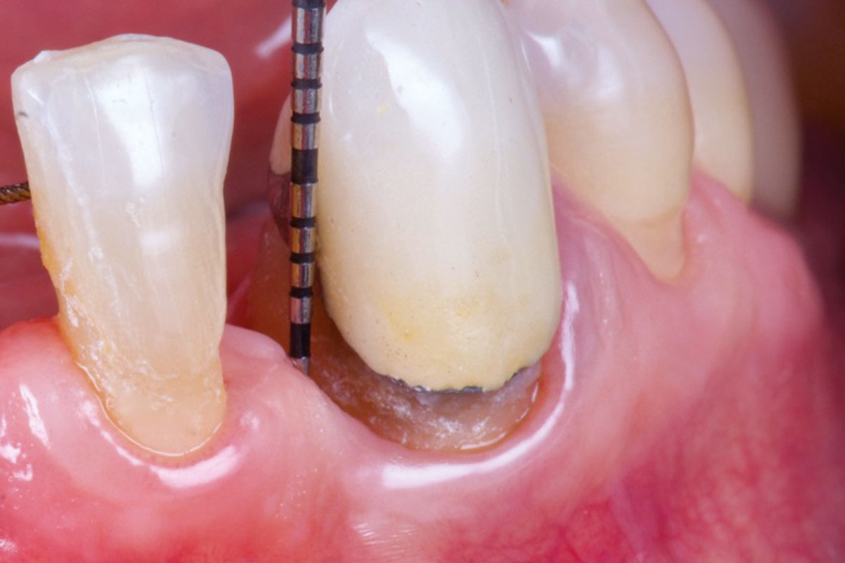 14----1-year_CASE_Rodrigo_Gonzalez_Terrats Clinical outcome at 12-month follow-up