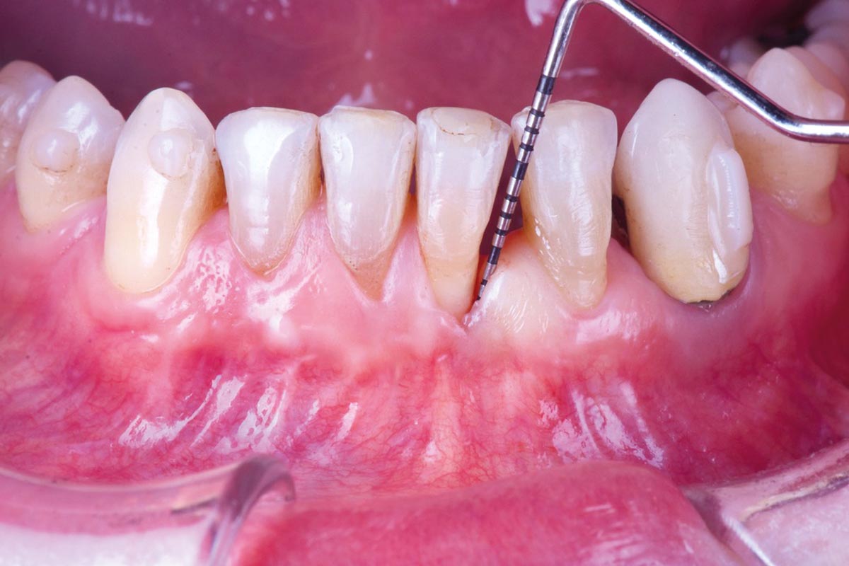 16---2.5-years_CASE_Rodrigo_Gonzalez_Terrats Clinical assessment at 2.5-year follow-up demonstrating stable periodontal conditions