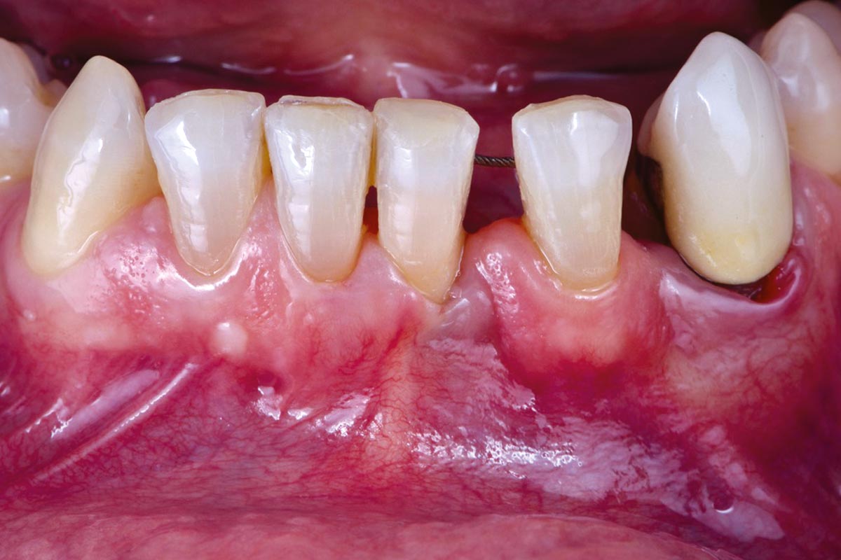 1_CASE_Rodrigo_Gonzalez_Terrats Initial periodontal status