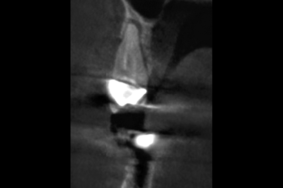 2--Pre-op-scan_Dr_Robert_Kemper Initial radiographic assessment. Missing buccal bone clearly visible