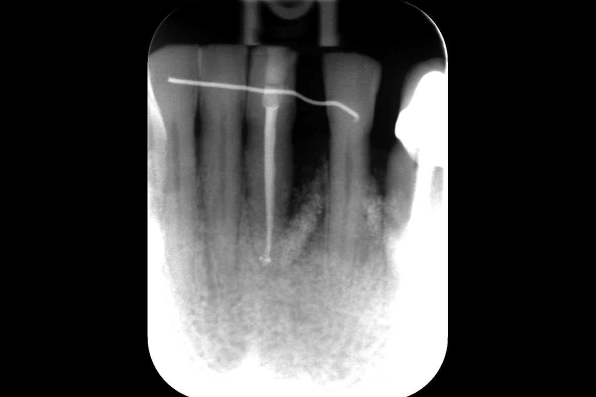 2.5-years_CASE_Rodrigo_Gonzalez_Terrats Radiographic outcome at 2.5-year follow-up