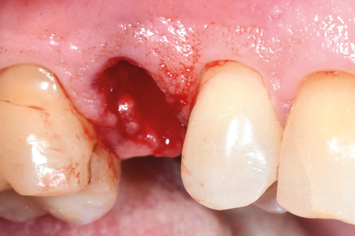 3--Socket-after-tooth-extraction_Dr_Robert_Kemper Post-extraction socket