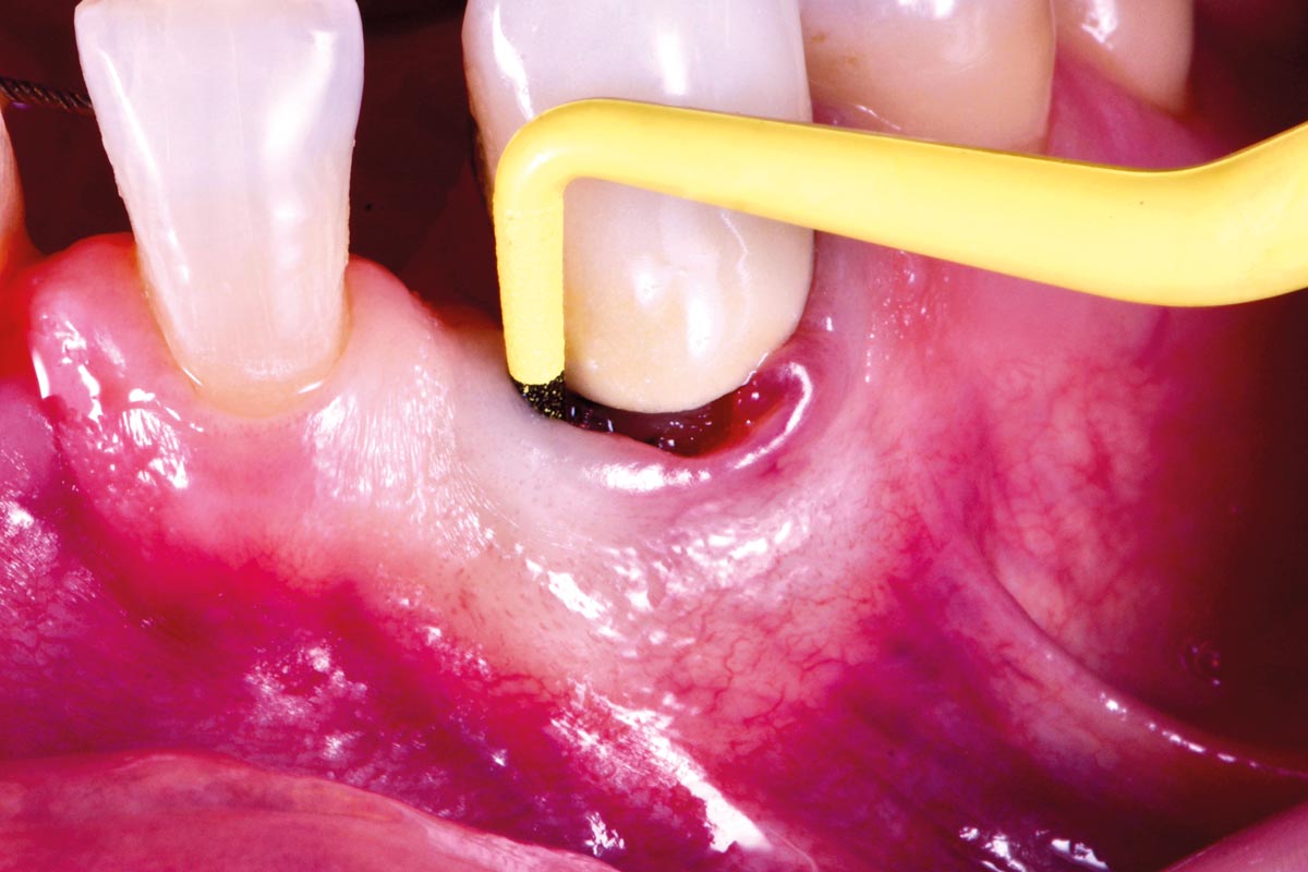 3_CASE_Rodrigo_Gonzalez_Terrats Baseline Probing Pocket Depth (PPD) assessment