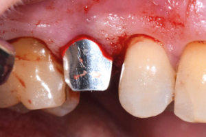 NOVAMag® SHIELD placement
