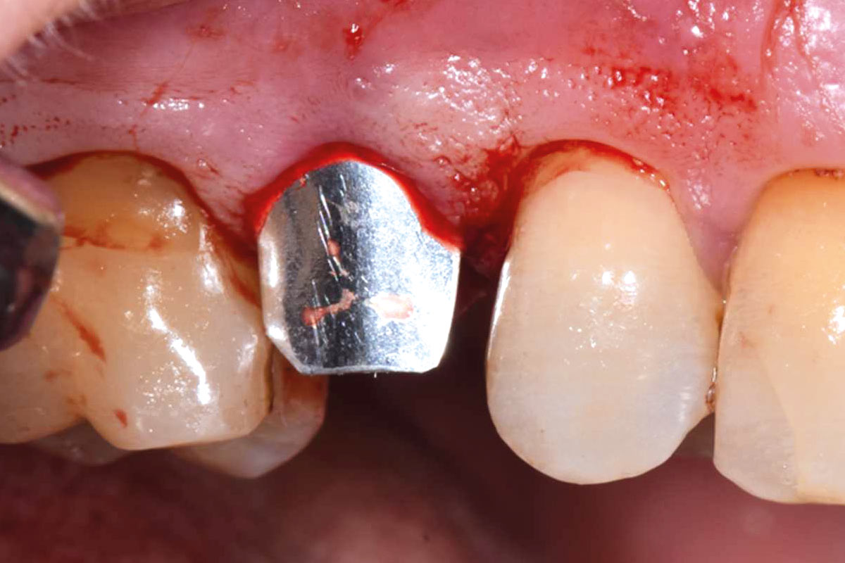 NOVAMag® SHIELD placement