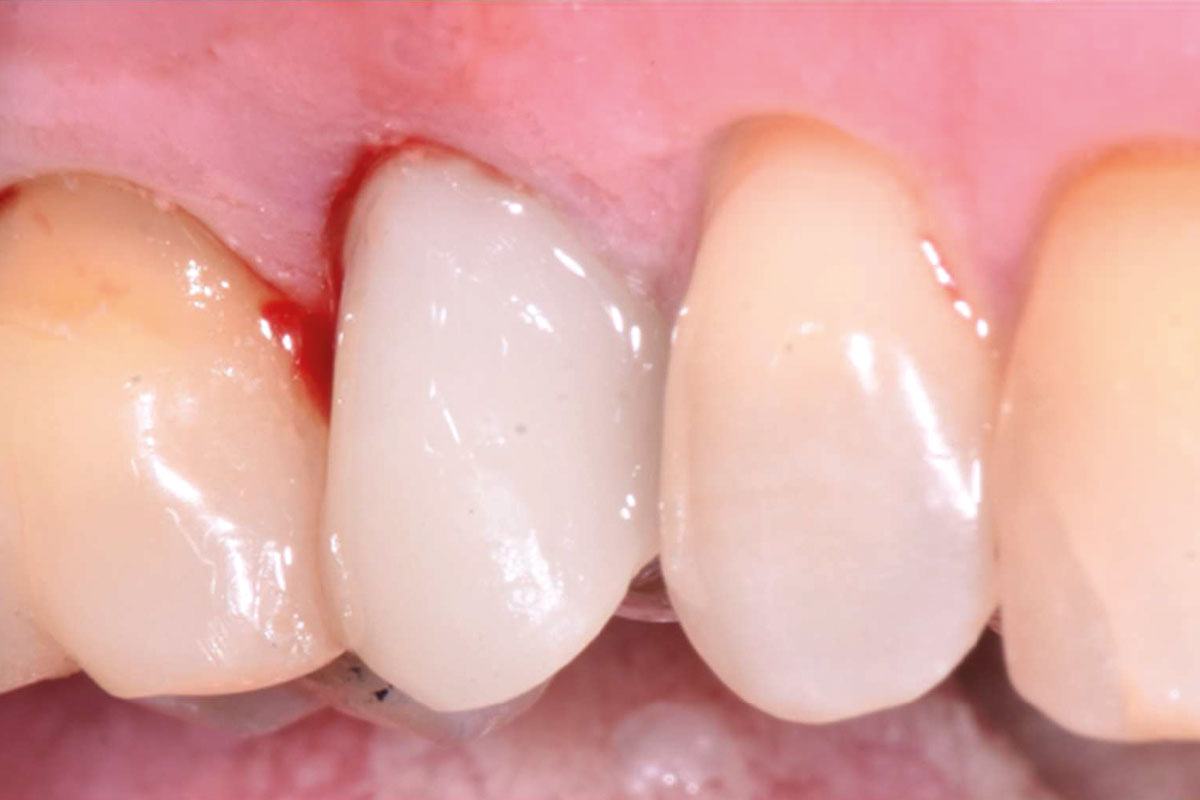 6--Post-op-clinical-situation_Dr_Robert_Kemper Post-operative clinical outcome: Immediate implantation & loading