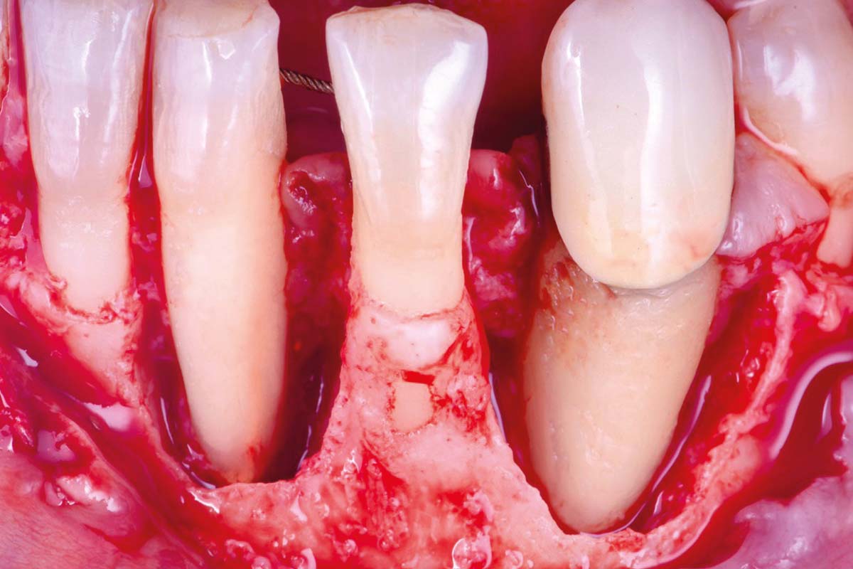 6_CASE_Rodrigo_Gonzalez_Terrats Minimally invasive Single Flap Approach (SFA)
