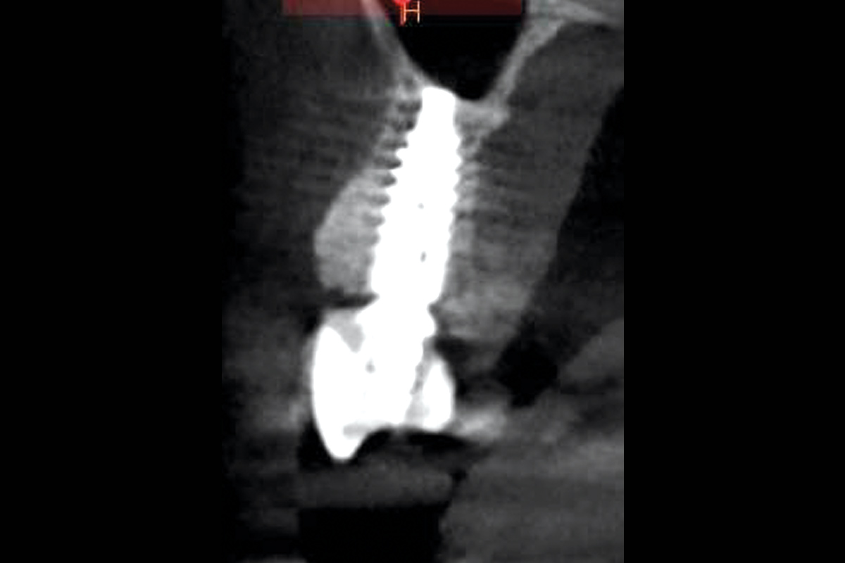 7--Post-op-scan-6-Months_Dr_Robert_Kemper Radiographic control after 6 months demonstrating stable bone regeneration