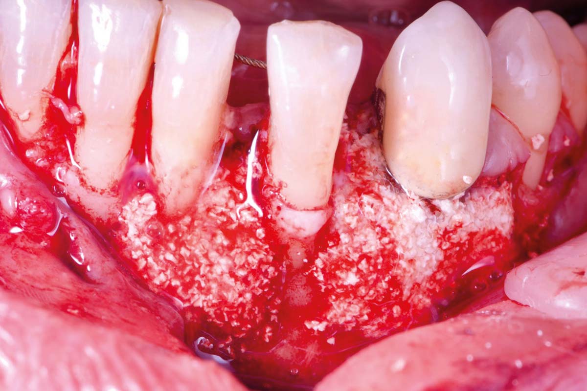 7_CASE_Rodrigo_Gonzalez_Terrats Periodontal regeneration combining EMD, cerabone® + HyA and Jason® membrane