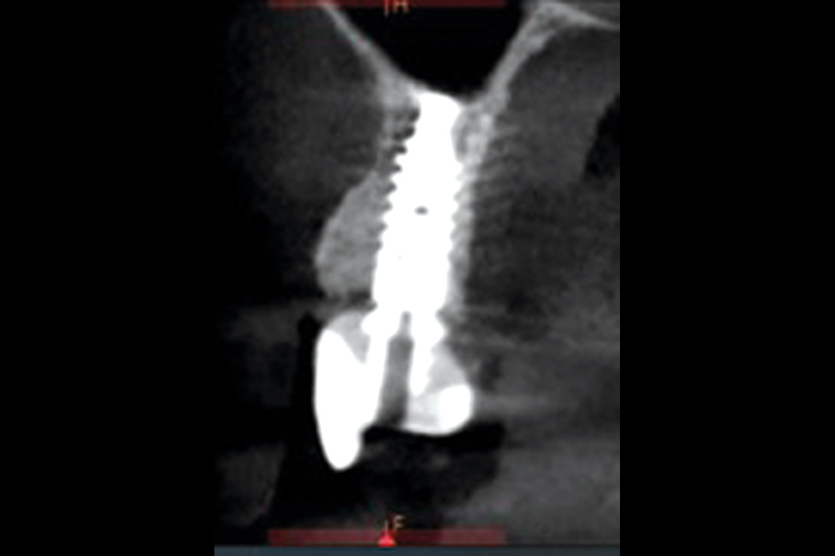 8--Post-op-12-Months_Dr_Robert_Kemper Radiographic control after 12 months demonstrating stable bone regeneration