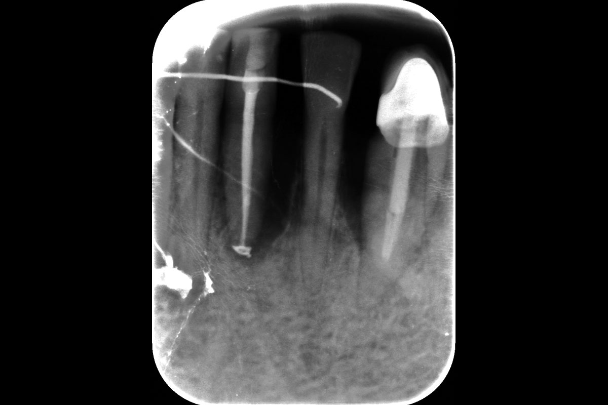 8-weeks_CASE_Rodrigo_Gonzalez_Terrats Radiographic re-evaluation of the EPL at tooth 31 after 6 weeks