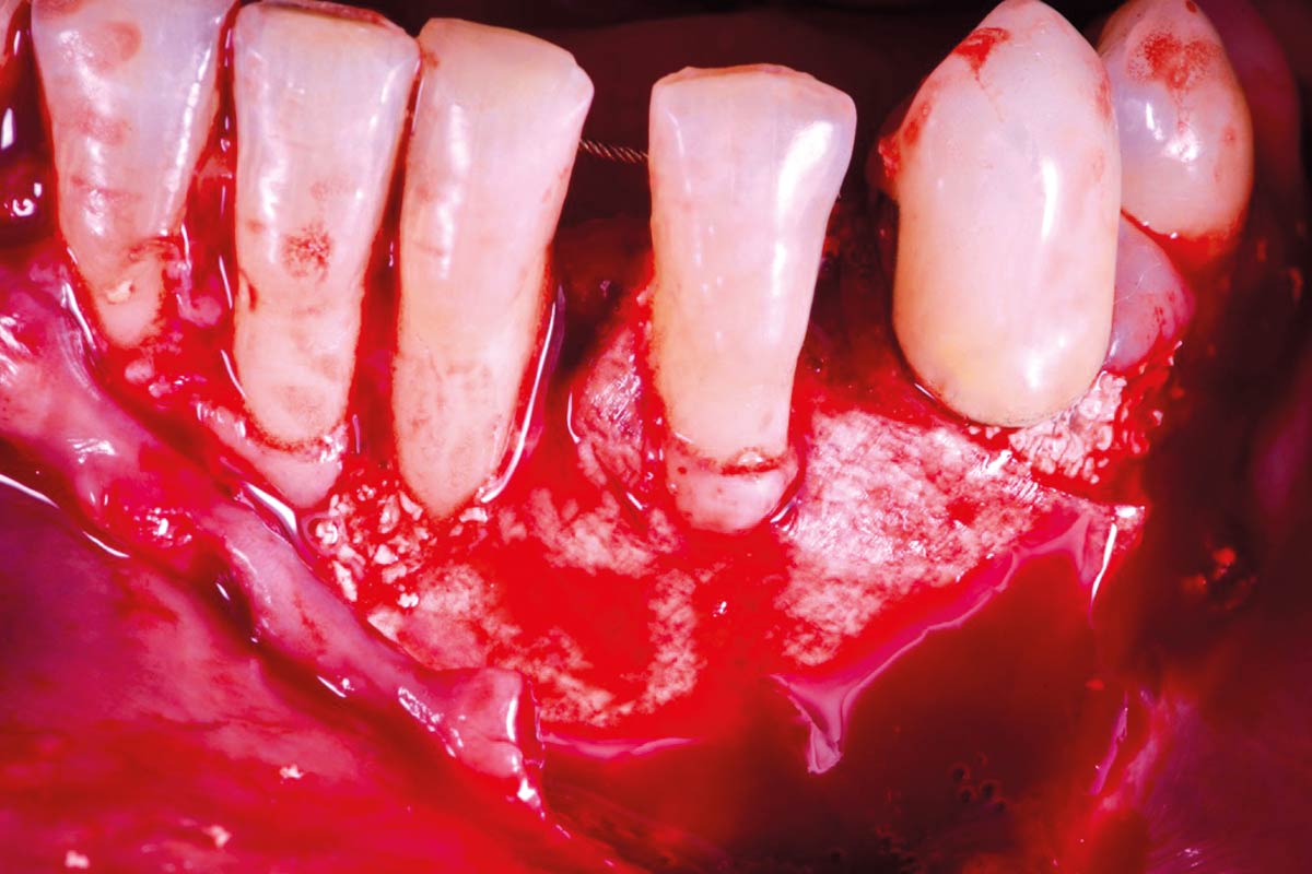 8_CASE_Rodrigo_Gonzalez_Terrats Periodontal regeneration combining EMD, cerabone® + HyA and Jason® membrane