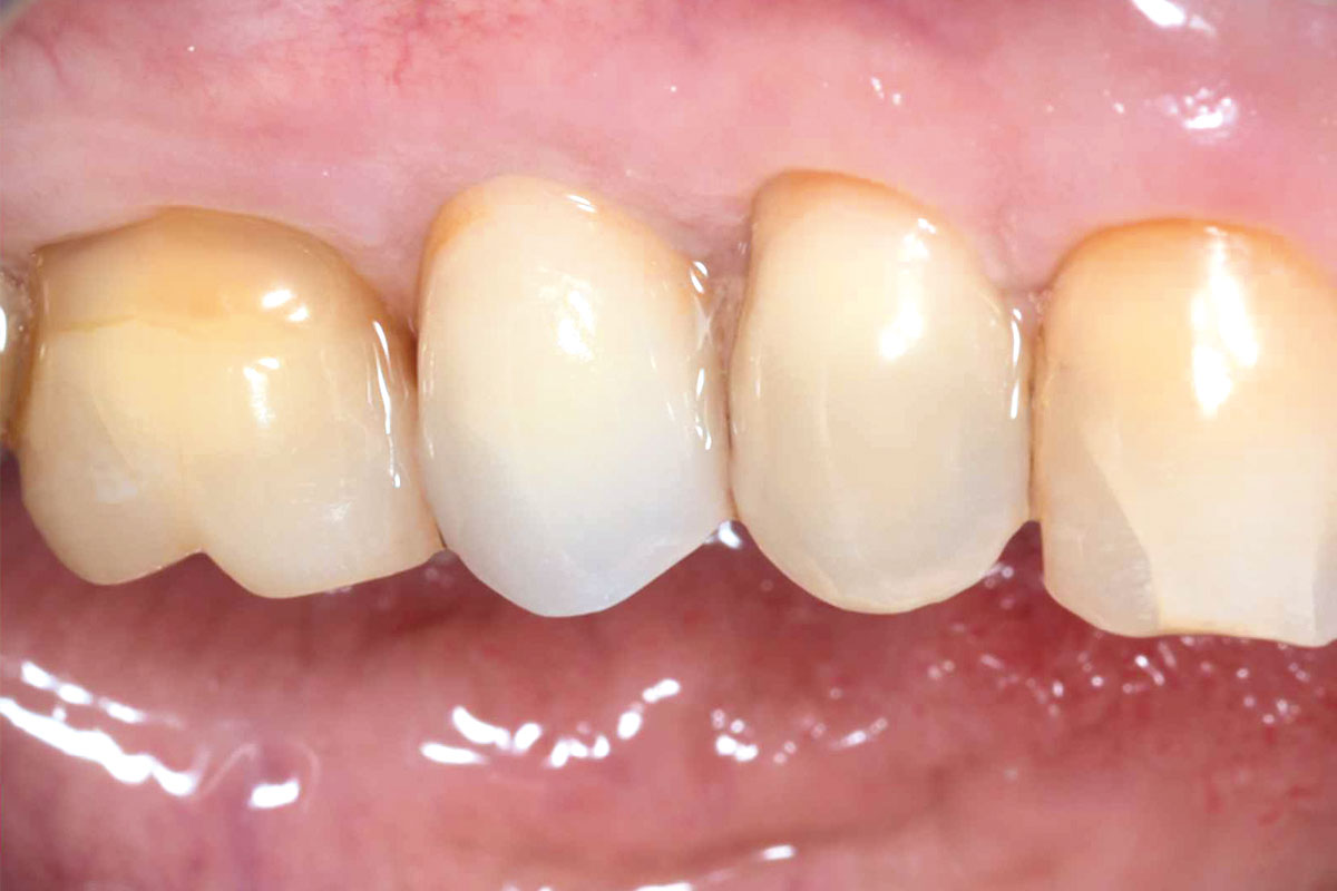 9--Final-outcome_Dr_Robert_Kemper Final prosthetic solution. Clinical follow-up after 14 months