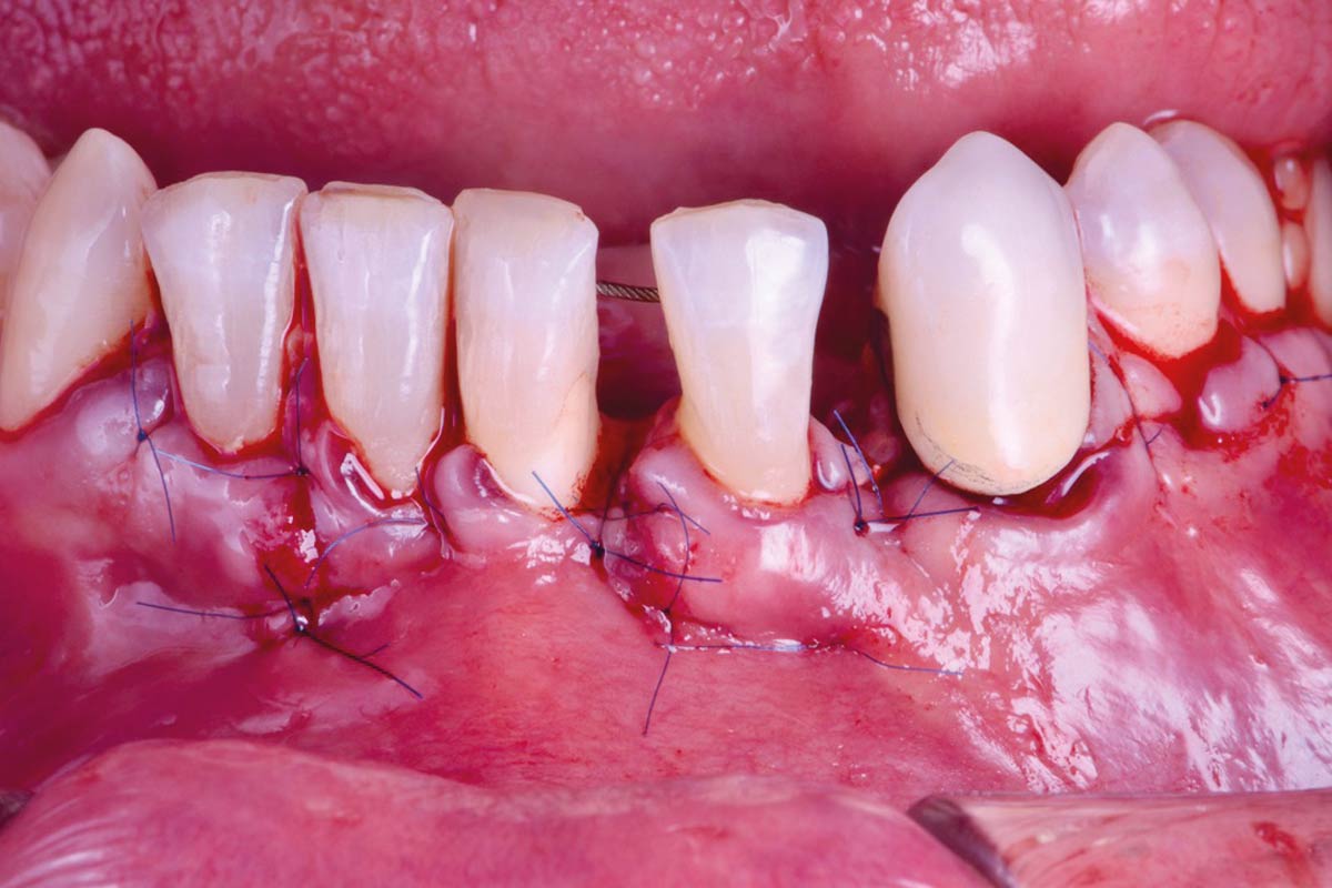 9_CASE_Rodrigo_Gonzalez_Terrats Suturing technique for primary wound closure
