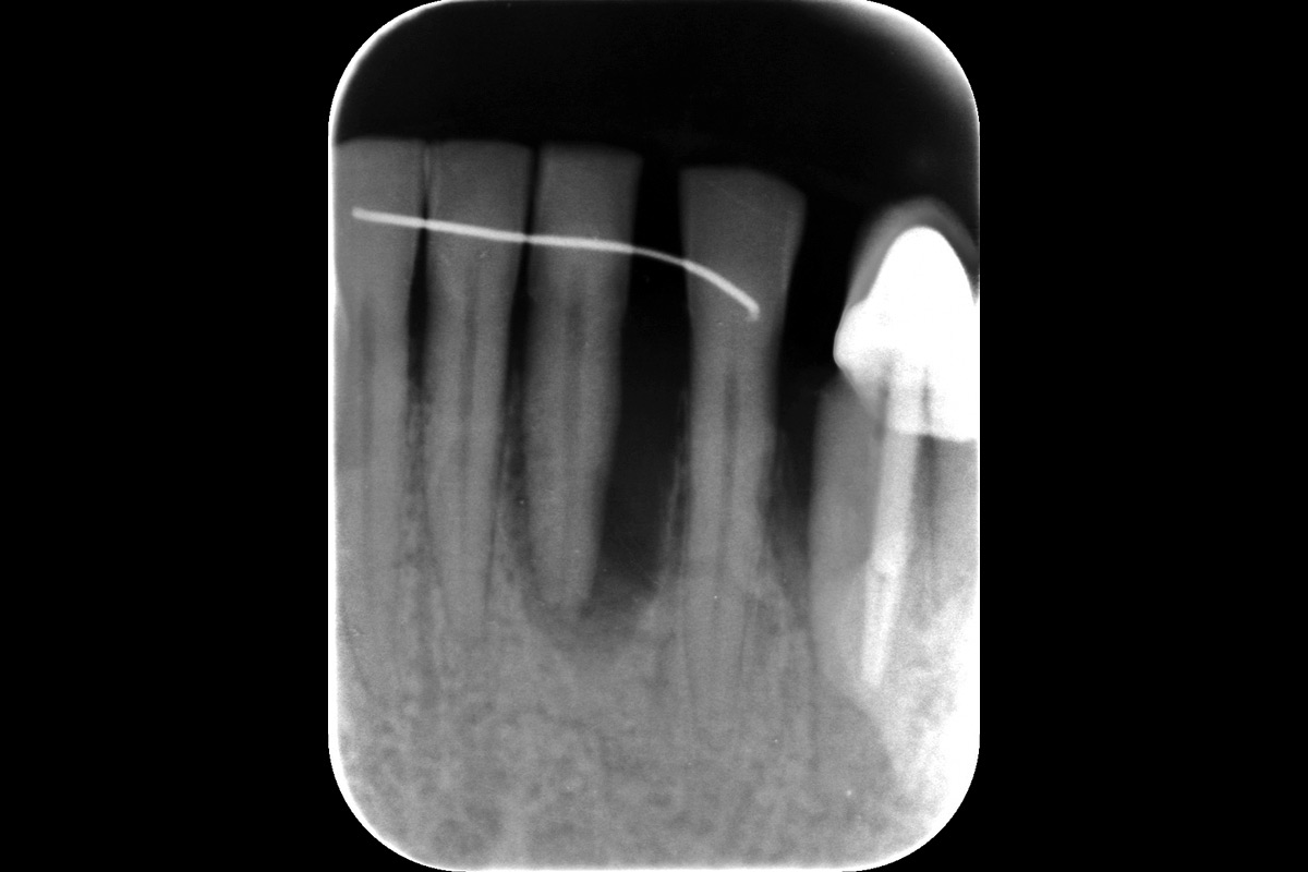 Initial-rx_CASE_Rodrigo_Gonzalez_Terrats Radiographic evaluation of the Endo-Periodontal Lesion (EPL) at tooth 31