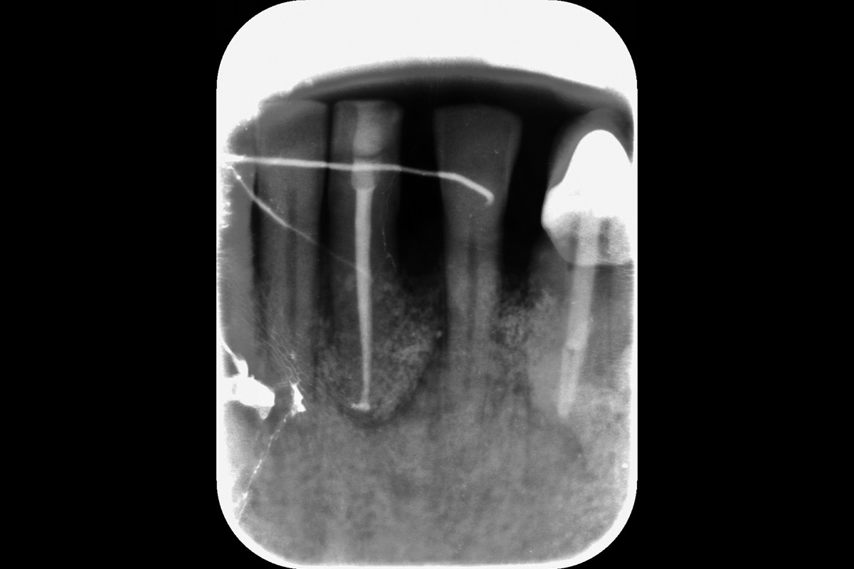 Surgery_CASE_Rodrigo_Gonzalez_Terrats Radiographic evidence of bone fill following regeneration