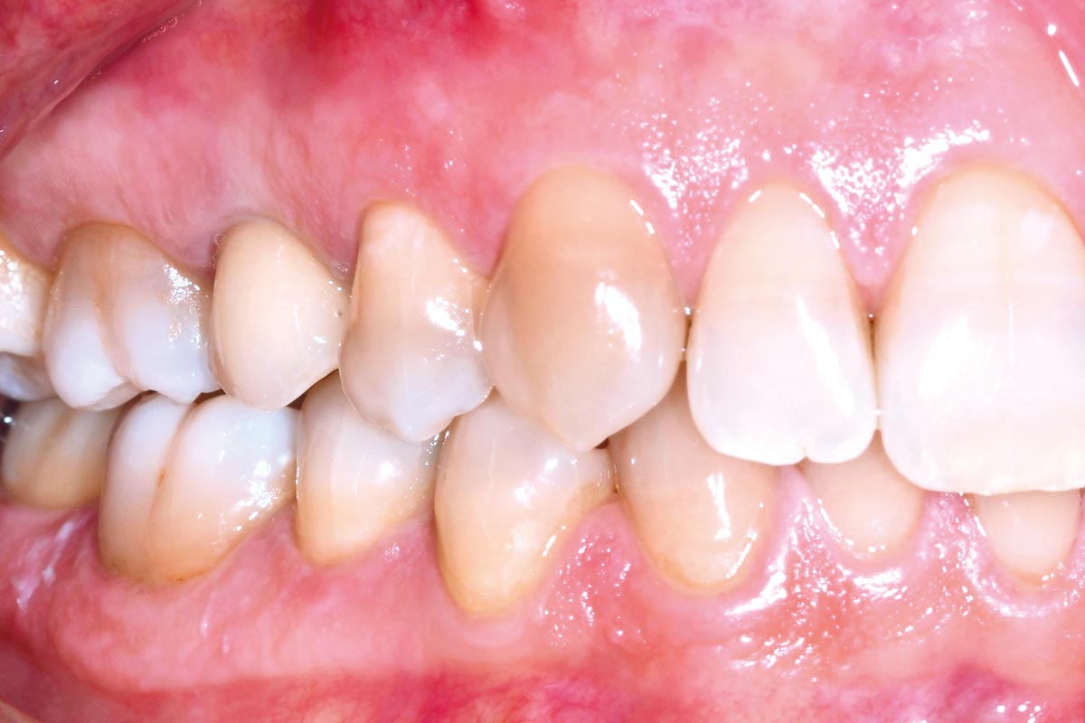 10-CASE_Piero_Papi_2026_10 Soft tissue situation after 10 years.