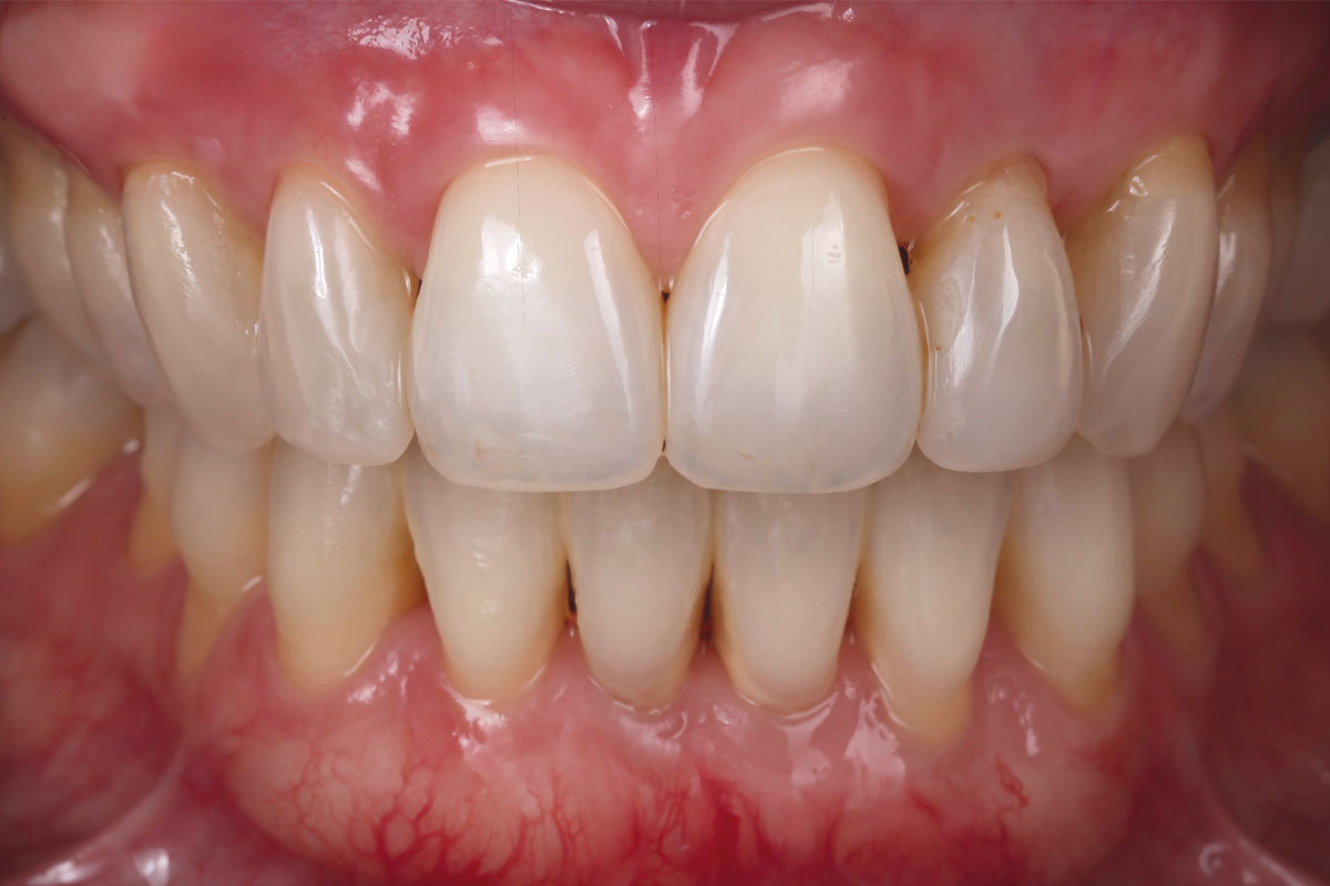 10_Case_Maria_Marta_Fernandez_06_2026 Five-year follow-up: Frontal view in occlusion.