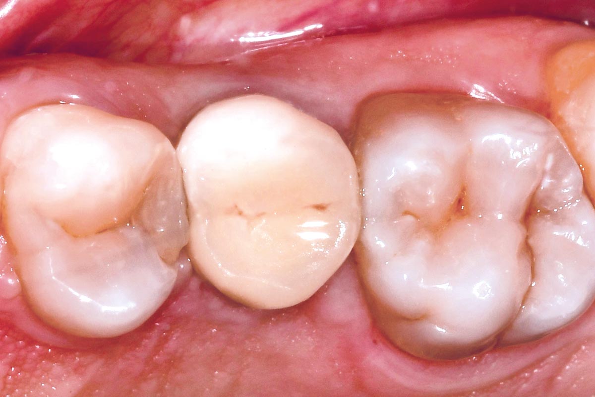 11-CASE_Piero_Papi_2026_11 10 years follow-up, occlusal view.