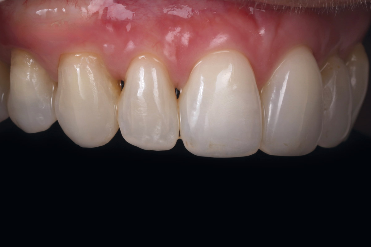 11_Case_Maria_Marta_Fernandez_06_2026 Five-year follow-up: Lateral view of the upper right dental arch.