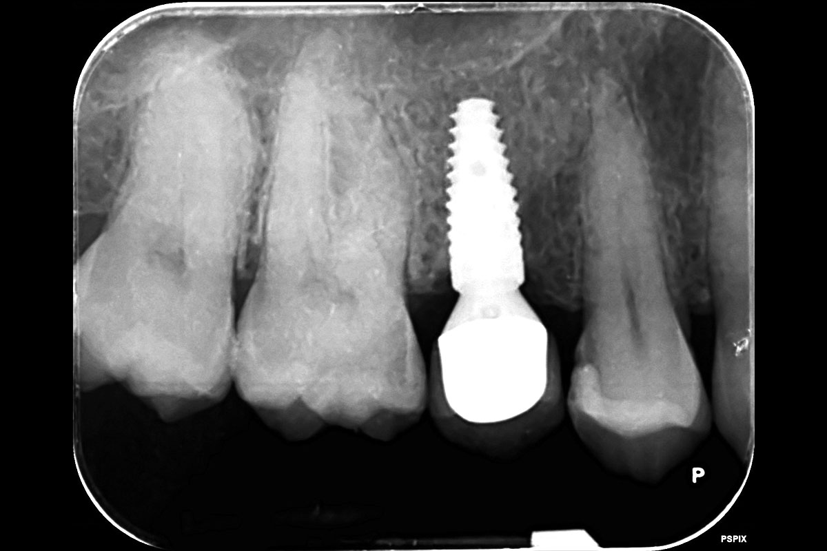12-CASE_Piero_Papi_2026_12 Scan 10 years after implant placement.
