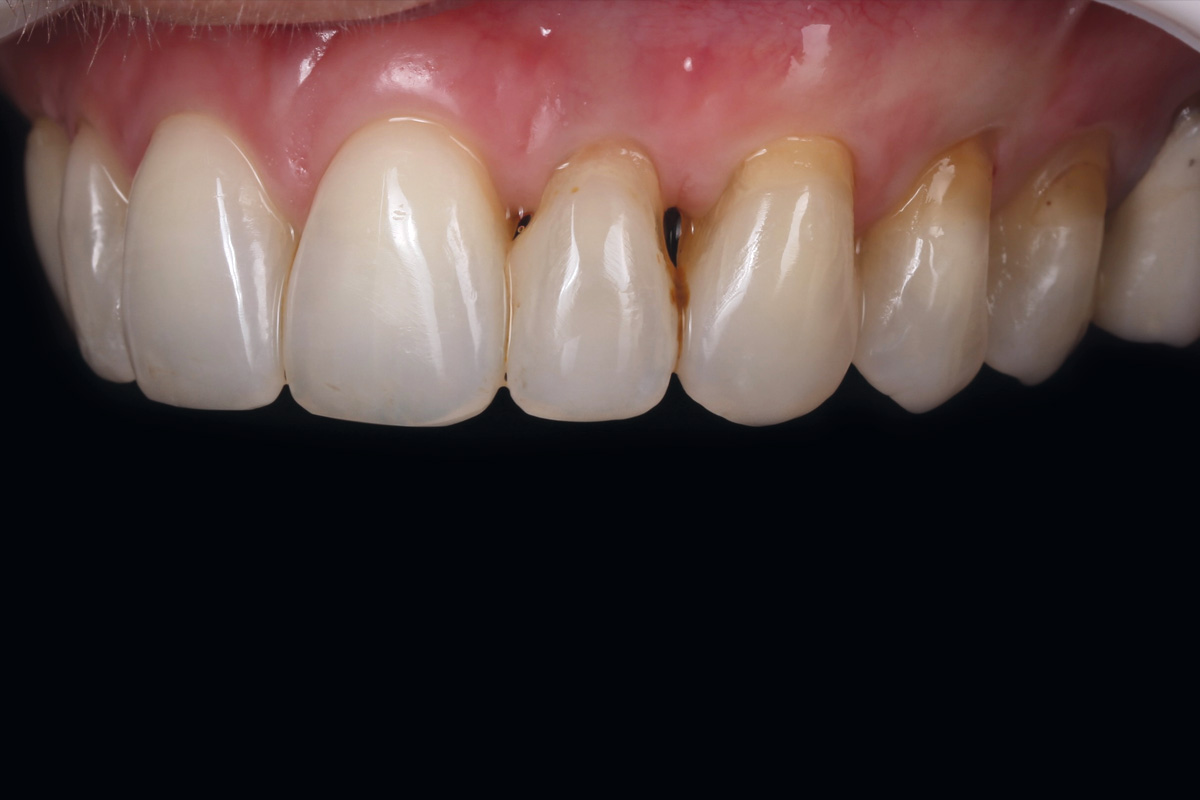 12_Case_Maria_Marta_Fernandez_06_2026 Five-year follow-up: Lateral view of the upper left dental arch.