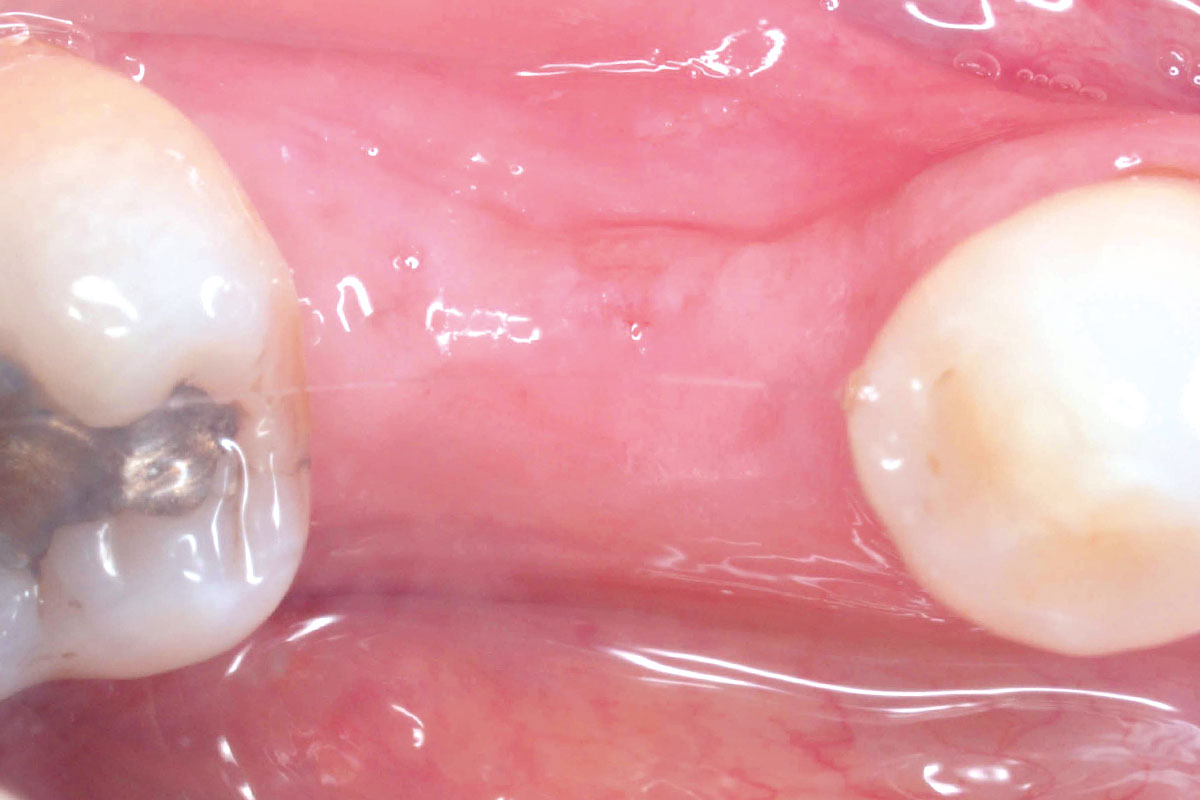 1_CASE_Stuardo_Valenzuela_2026 Initial clinical situation: Missing tooth in the posterior mandible (tooth 46).