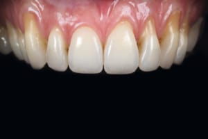 Initial clinical situation, frontal view showing multiple gingival recessions.