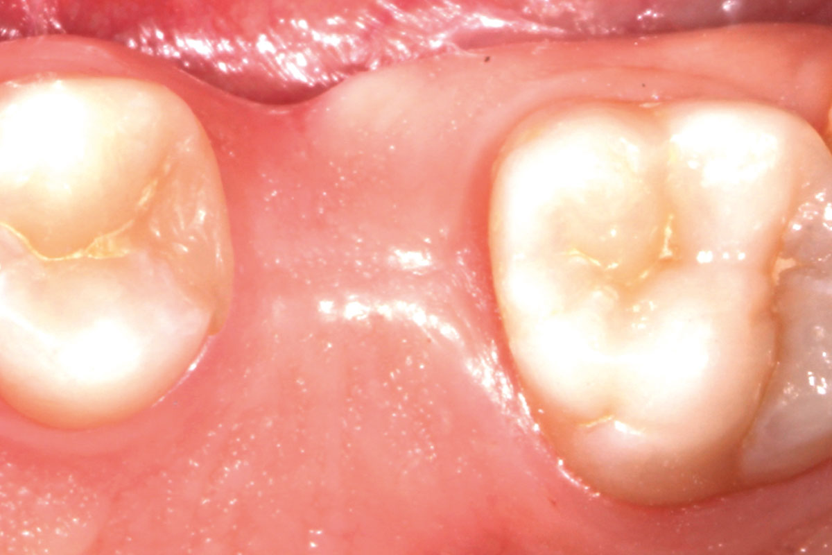 2-CASE_Piero_Papi_2026_2 Occlusal view of the initial situation.