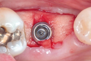 Placement of mucoderm® to achieve horizontal and vertical soft tissue augmentation.