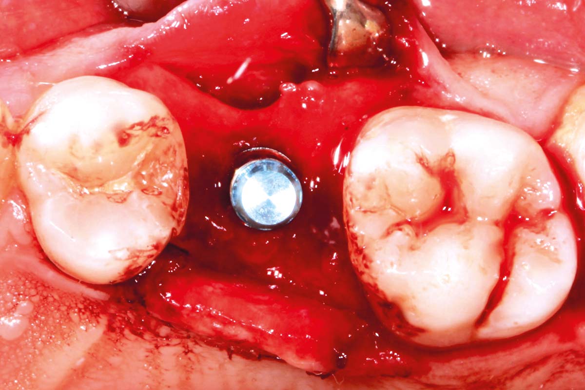3-CASE_Piero_Papi_2026_3 Implant placement.