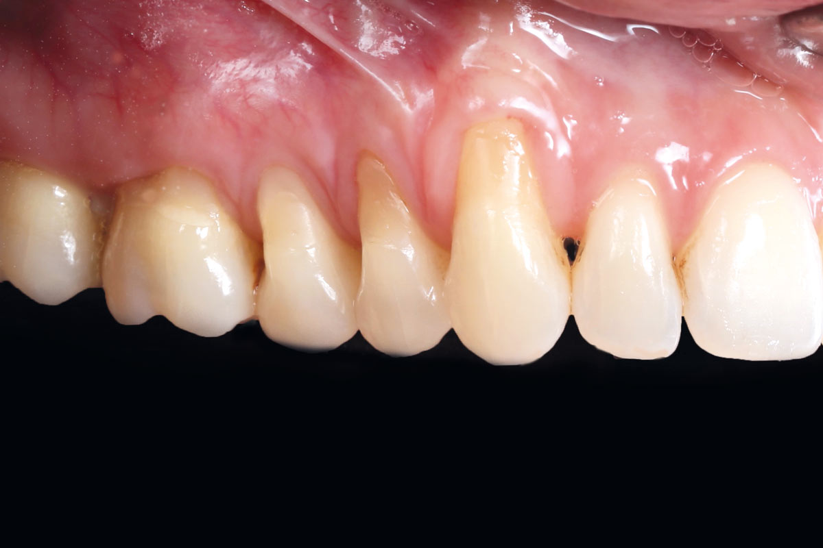 3_Case_Maria_Marta_Fernandez_06_2026 Initial clinical situation: Lateral view of the upper right dental arch.