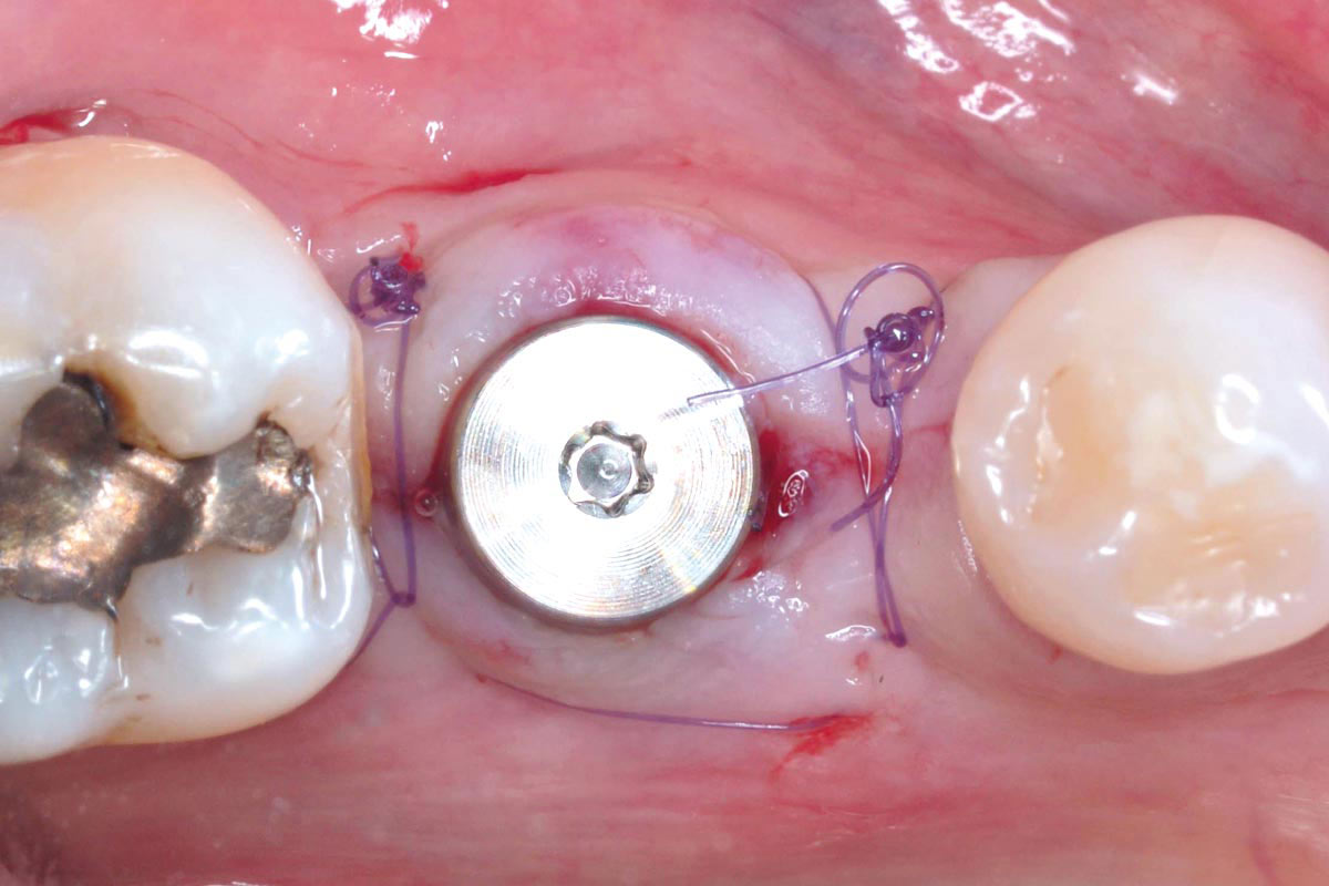 4_CASE_Stuardo_Valenzuela_2026 Primary wound closure with sutures, ensuring complete coverage of the mucoderm® matrix.