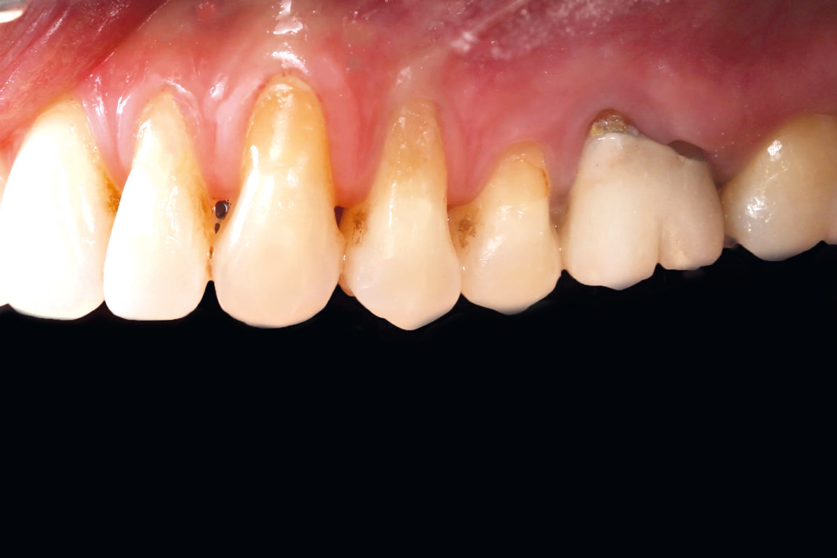 4_Case_Maria_Marta_Fernandez_06_2026 Initial clinical situation: Lateral view of the upper left dental arch.