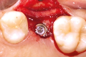 Positioning of mucoderm® on the buccal aspect.