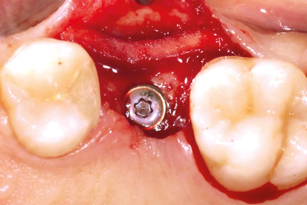 Positioning of mucoderm® on the buccal aspect.