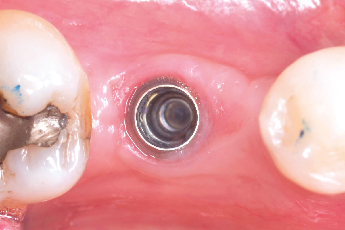 5_CASE_Stuardo_Valenzuela_2026 Occlusal view 3 months postoperatively, demonstrating favorable soft tissue healing and volume gain.