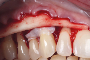 Following elevation of the flap, mucoderm® matrix was applied. In addition, a connective tissue graft was placed in tooth 13 and 14.