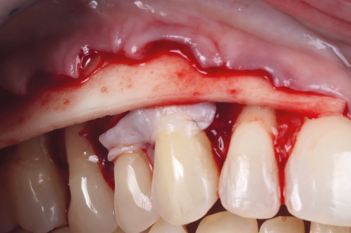Following elevation of the flap, mucoderm® matrix was applied. In addition, a connective tissue graft was placed in tooth 13 and 14.