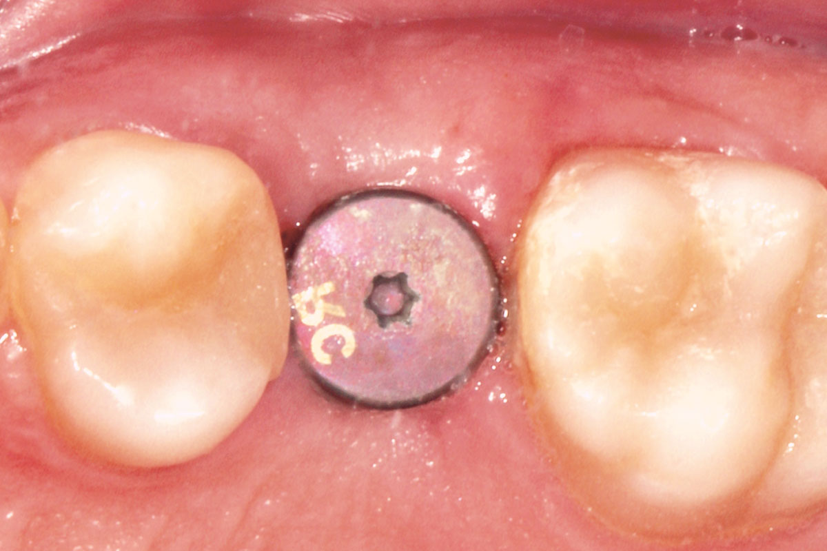 6-CASE_Piero_Papi_2026_6 1 month after soft tissue augmentation.