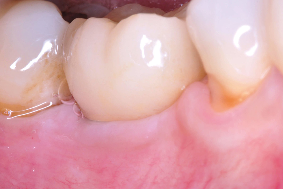 6_CASE_Stuardo_Valenzuela_2026 Placement of the screw-retained monolithic lithium disilicate crown.