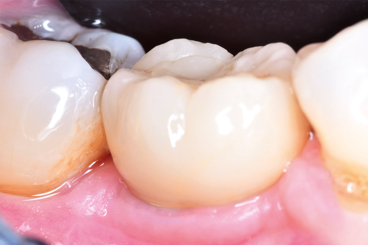 7_CASE_Stuardo_Valenzuela_2026 One-year follow-up demonstrating stable peri-implant soft tissue conditions with further improvement in tissue thickness.