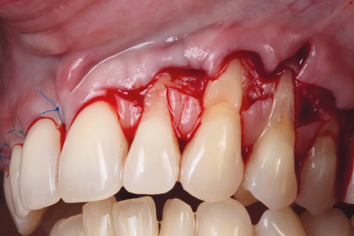 7_Case_Maria_Marta_Fernandez_06_2026 Elevation of the coronally advanced flap in the contralateral treatment area prior to mucoderm® application.