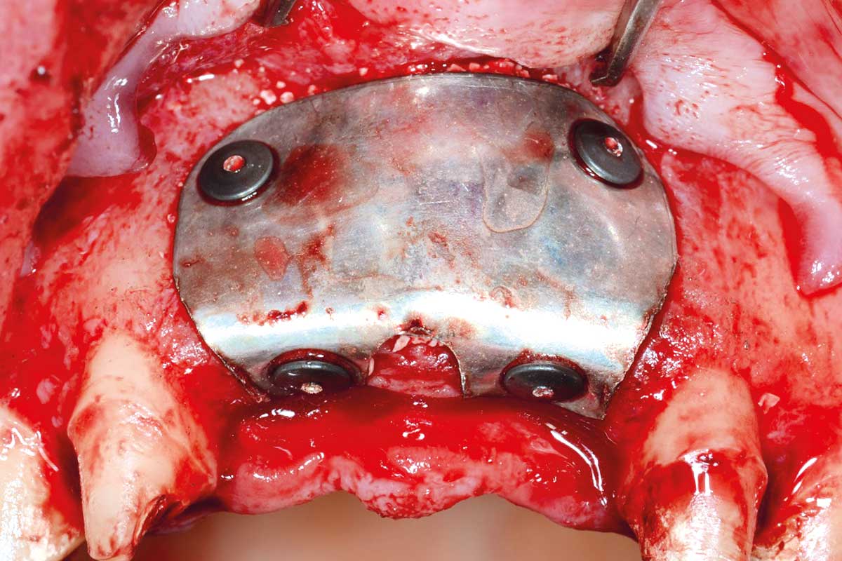 Fixation of the NOVAMag® membrane using NOVAMag® Fixation Screws