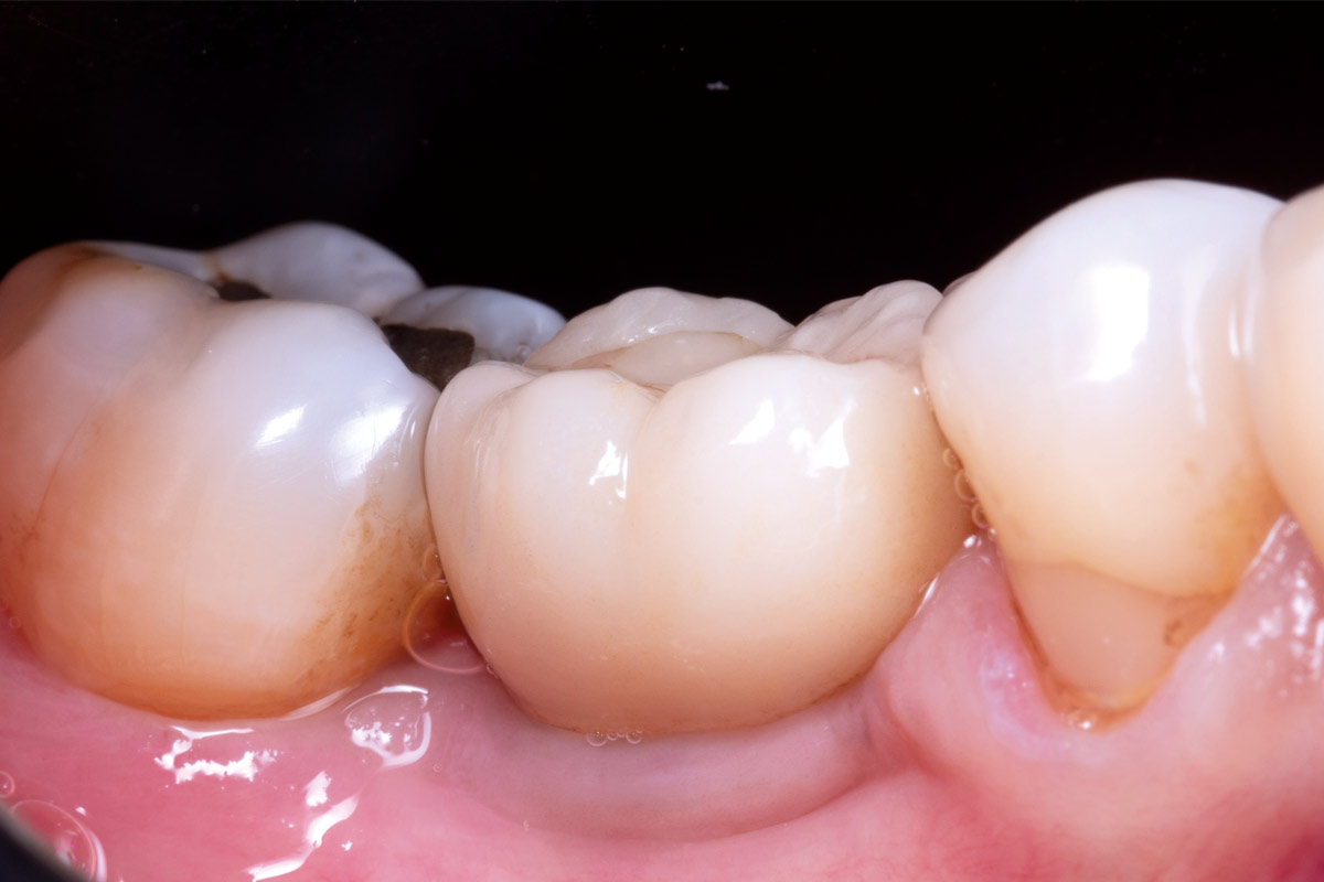 8_CASE_Stuardo_Valenzuela_2026 Five-year follow-up demonstrating stable peri-implant soft tissue conditions and long-term tissue maturation.