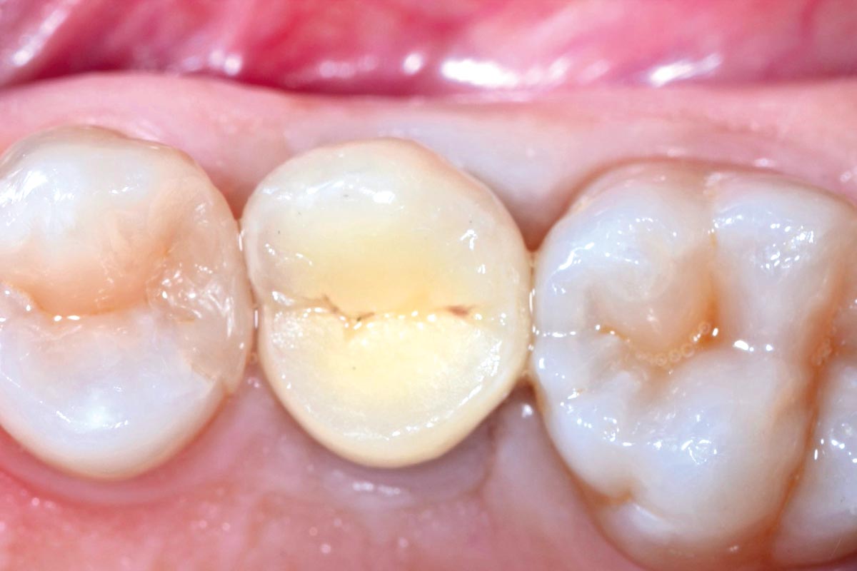 9-CASE_Piero_Papi_2026_9 Occlusal view, 8 years after soft tissue augmentation.