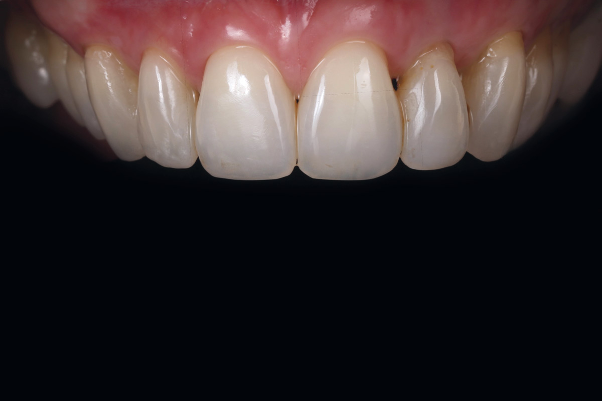 9_Case_Maria_Marta_Fernandez_06_2026 Five-year follow-up: Frontal view demonstrating stable root coverage and soft tissue integration and volume retention.
