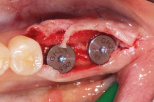 Buccal soft tissue augmentation with mucoderm® to increase thickness, followed by placement of healing abutments for open healing.